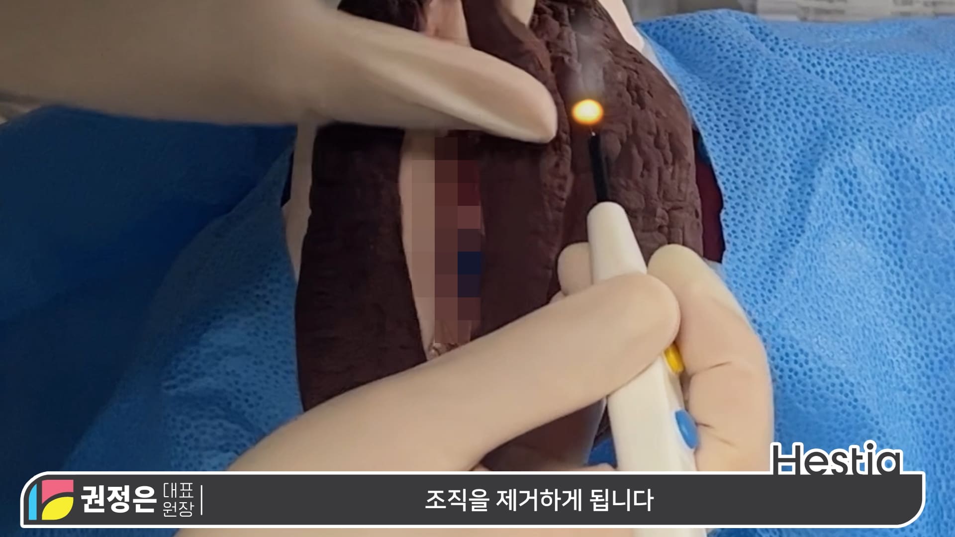 대음순성형수술 시물레이션