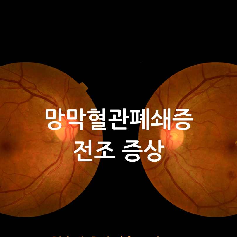 망막혈관폐쇄증(눈중풍)