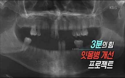[670회] 생로병사의 비밀 - KBS670회] 생로병사의 비밀.ts_20220505_141700.661.jpg