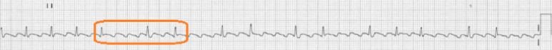 atrial flutter with variable block