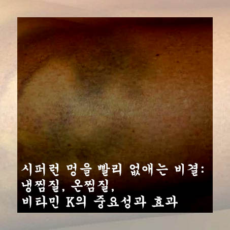  시퍼런 멍을 빨리 없애는 비결: 냉찜질, 온찜질, 비타민 K의 중요성과 효과
