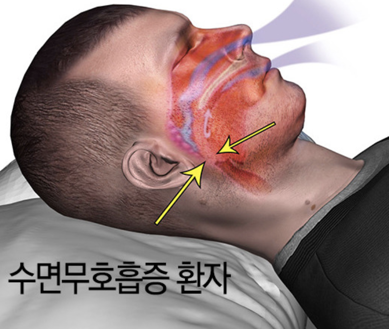  수면무호흡증 30분 혀운동으로 고치기