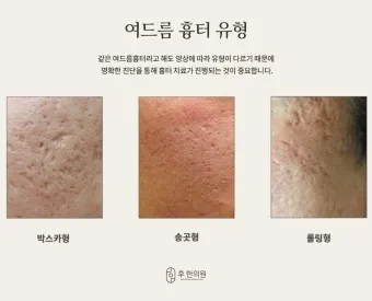 흉터전용 치료 추천 스카덤 겔 효능효과_14