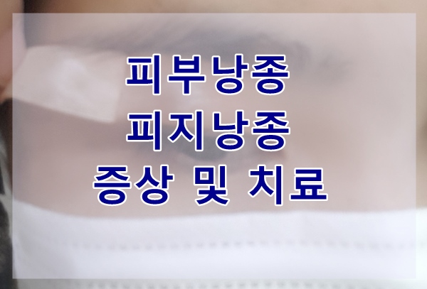  피부낭종,피지낭종 증상 및 치료방법
