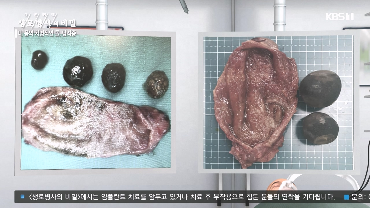 생로병사의 비밀.E886.231019p-NEXT.mp4_20231019_203447.623.jpg