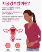  자궁경부암 예방접종 가격 및 시기