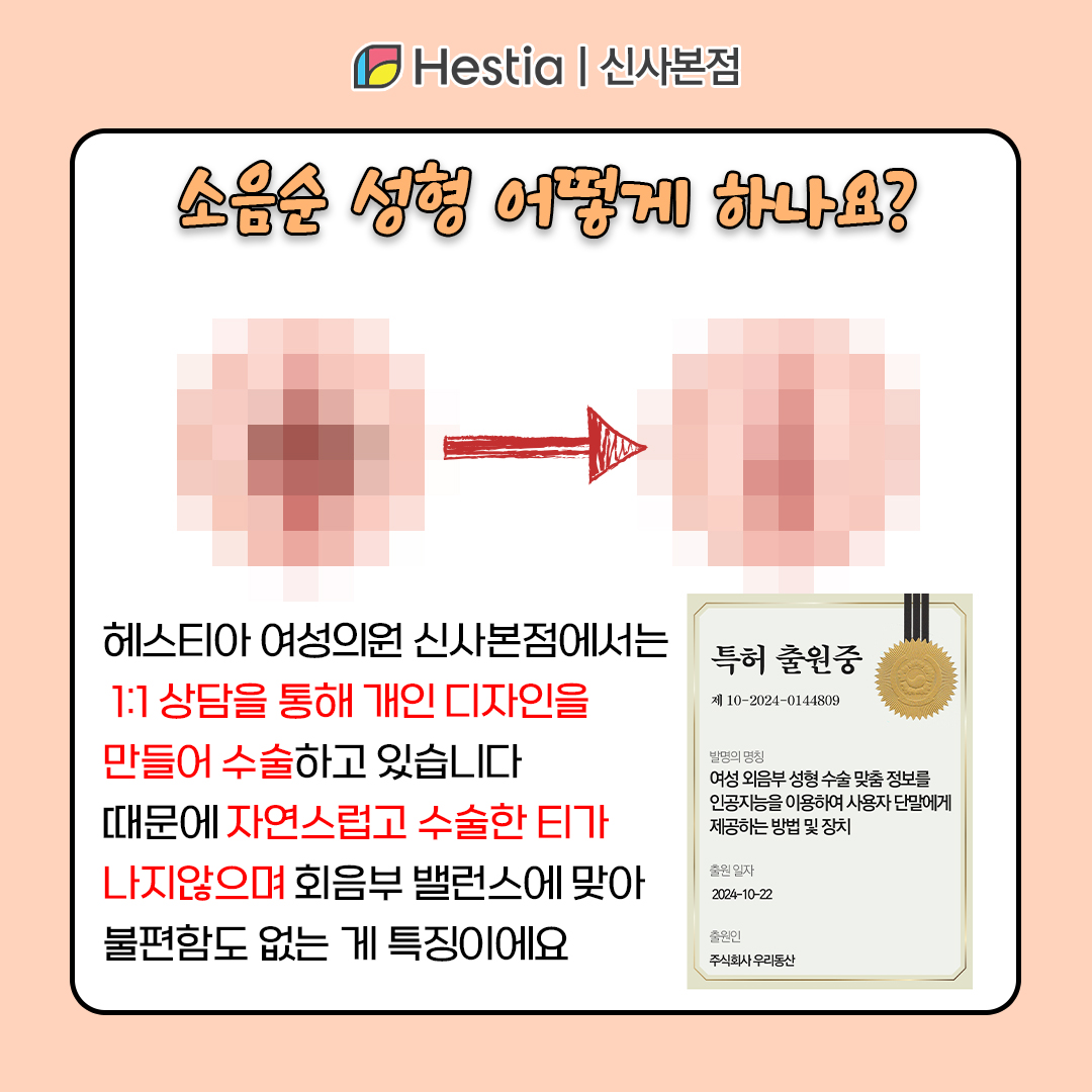 생식기 상처 압구정로데오역산부인과 소음순부음 통증 소음순 성형 방법 알아보자