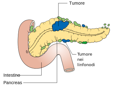 췌장암 위치 출처 : commons.wikimedia.org