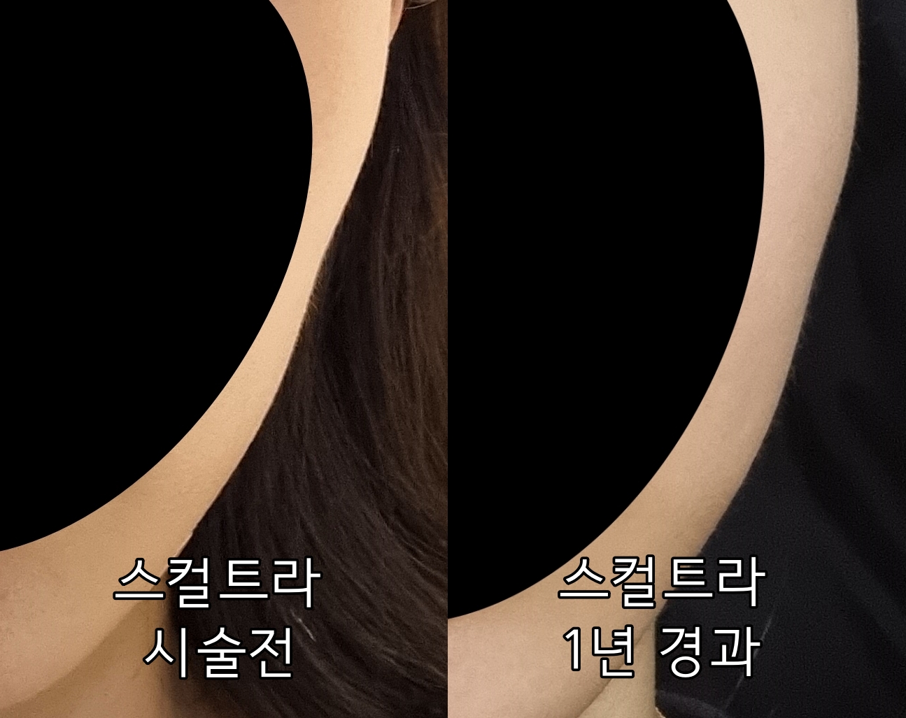  내돈내산 스컬트라 옆볼, 관자, 팔자 최종후기! 전후사진, 효과, 부작용, 피부과 시술 계획
