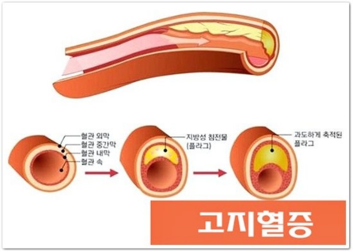 고지혈증-증상-원인-좋은음식-나쁜음식