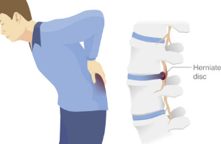 허리 디스크 다리 저림