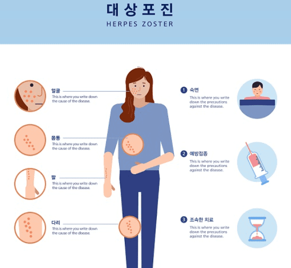  대상포진 증상 원인 치료방법 예방접종가격/대상 포진 비슷한 증상 은?
