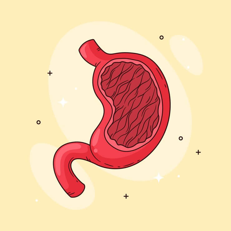  위궤양 (Peptic Ulcer) 발생 원인과 치료방법들