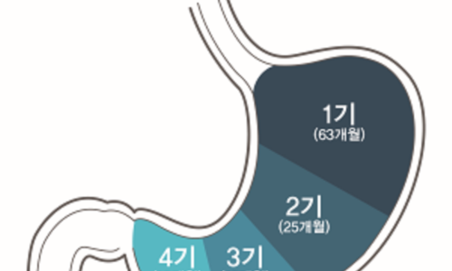 위암 이미지