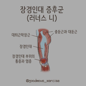 장경인대-증후군