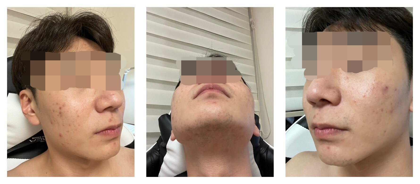 신촌 스킨케어 건성 피부 여드름 케어 받으러 신촌 배꽃향기 다녀오기