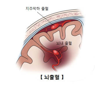 뇌졸중(뇌출혈)원인&#44;초기증상&#44;복용하는약&#44;알티지오메가3