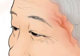 측두동맥염(Temporalarteritis)의 원인 및 증상 치료에 대하여 2