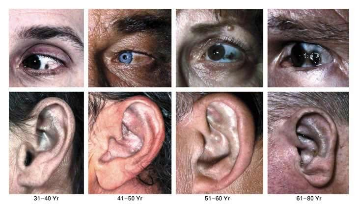 연령대별 눈과 귀에 나타난 알캅톤뇨증 증상