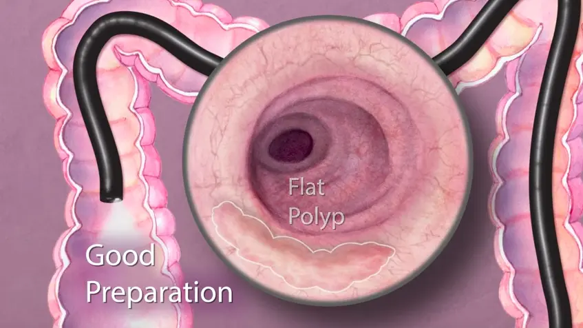 대장내시경 모습