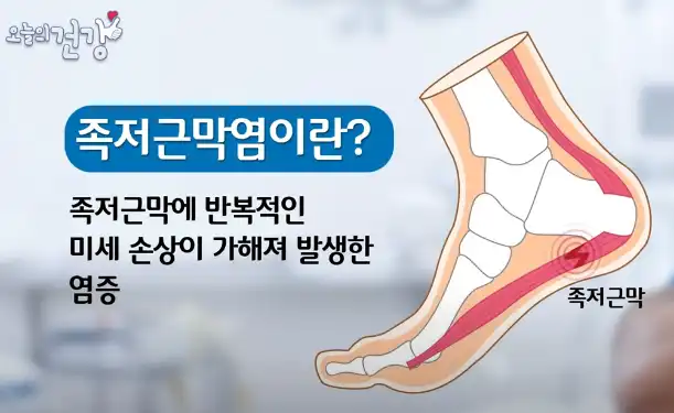족저근막염