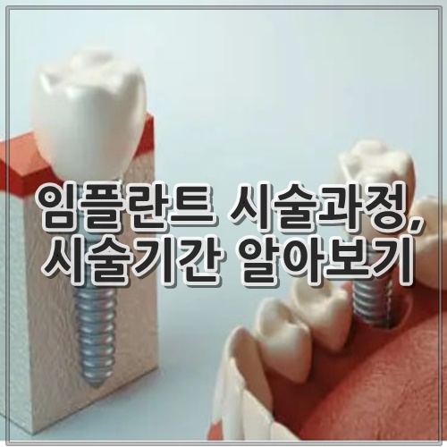 임플란트 시술과정, 시술기간 알아보기