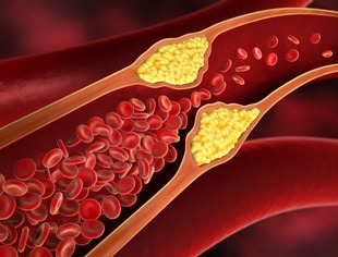 콜레스테롤 높으면 나타나는 증상