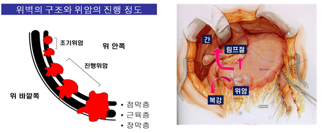 위암