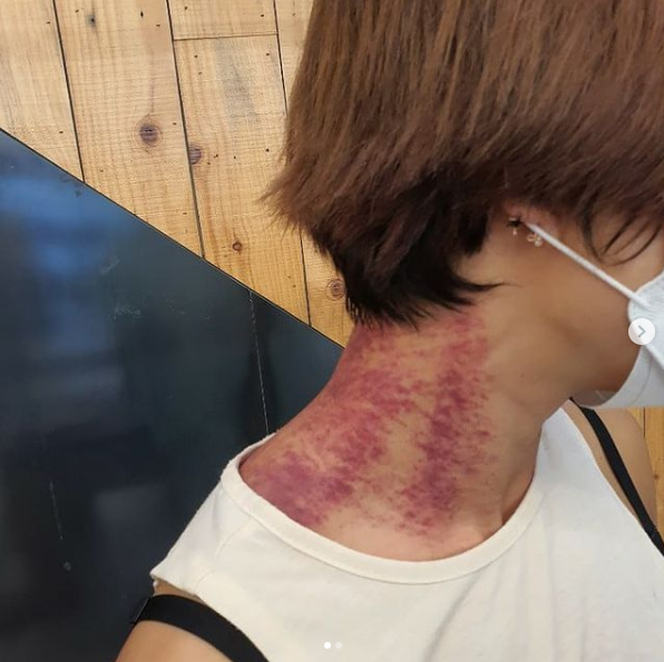  개그우먼 김혜선 시퍼런 피멍, 팬들이 경악한 이유