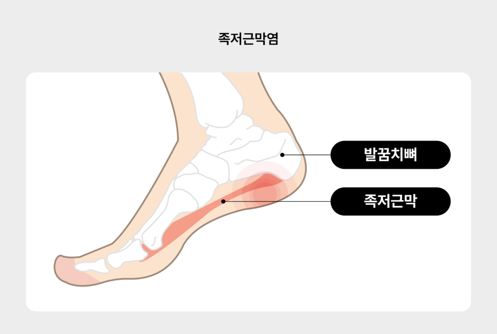 족저근막염 신발 추천