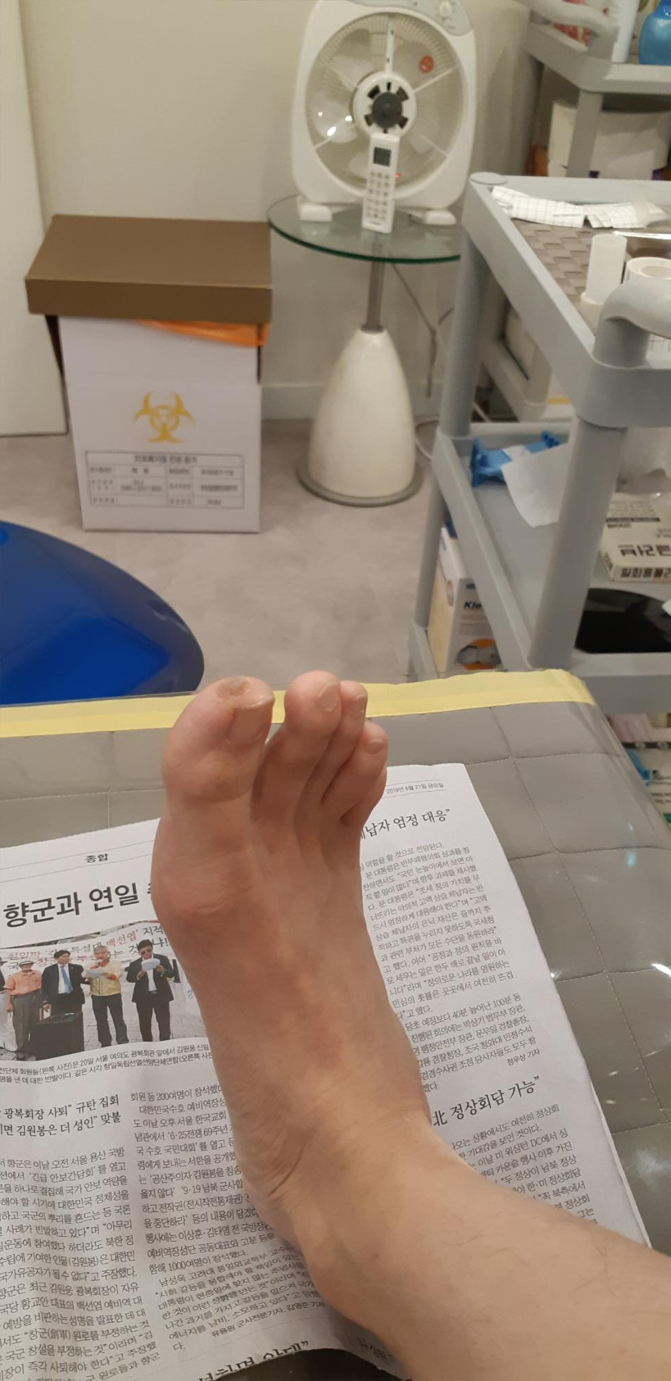  피부과 사마귀제거 솔직후기 D-0 (T)