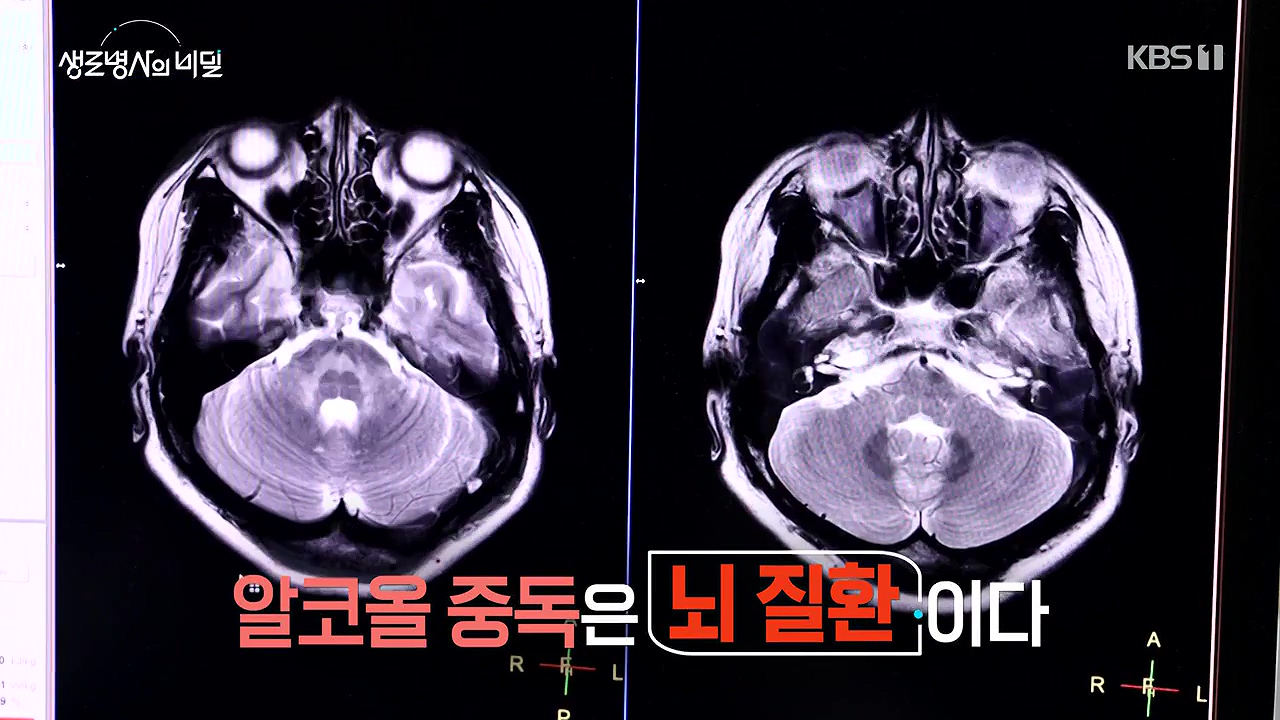 생로병사의 비밀.E915.240613p-NEXT.mp4_20240613_195302.297.jpg