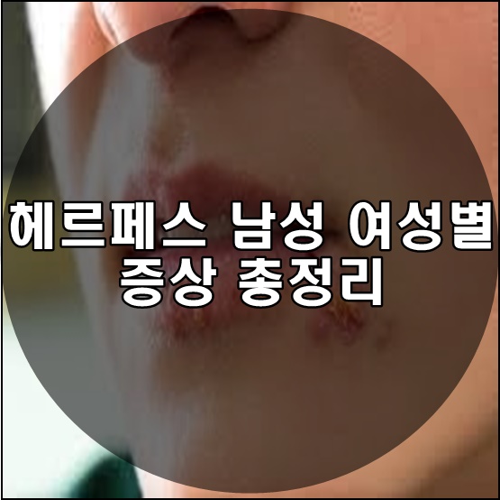  헤르페스 남성 여성별 증상 총정리