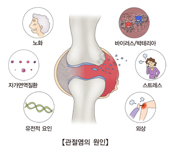  관절염 통증 [관절염 종류와 치료]