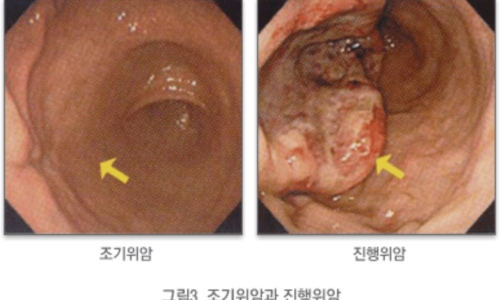 위암 이미지