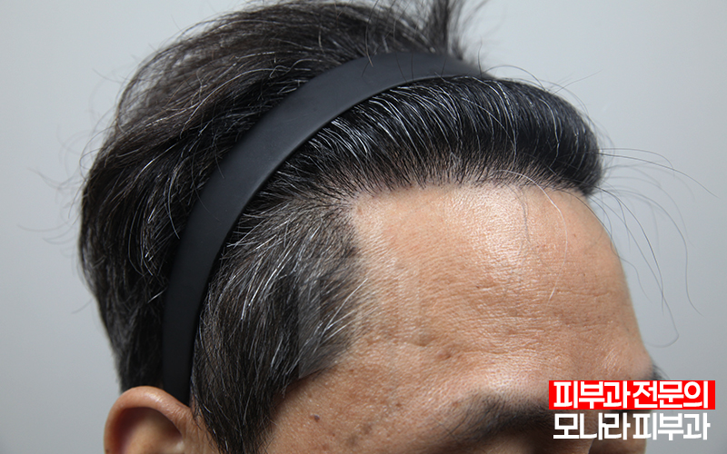 강남 모발이식 3000모 가격 병원 선택 꿀팁