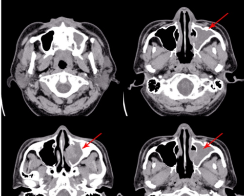 뇌 CT사진으로 부비강염 위치를 네컷으로 화살표 표시한 사진