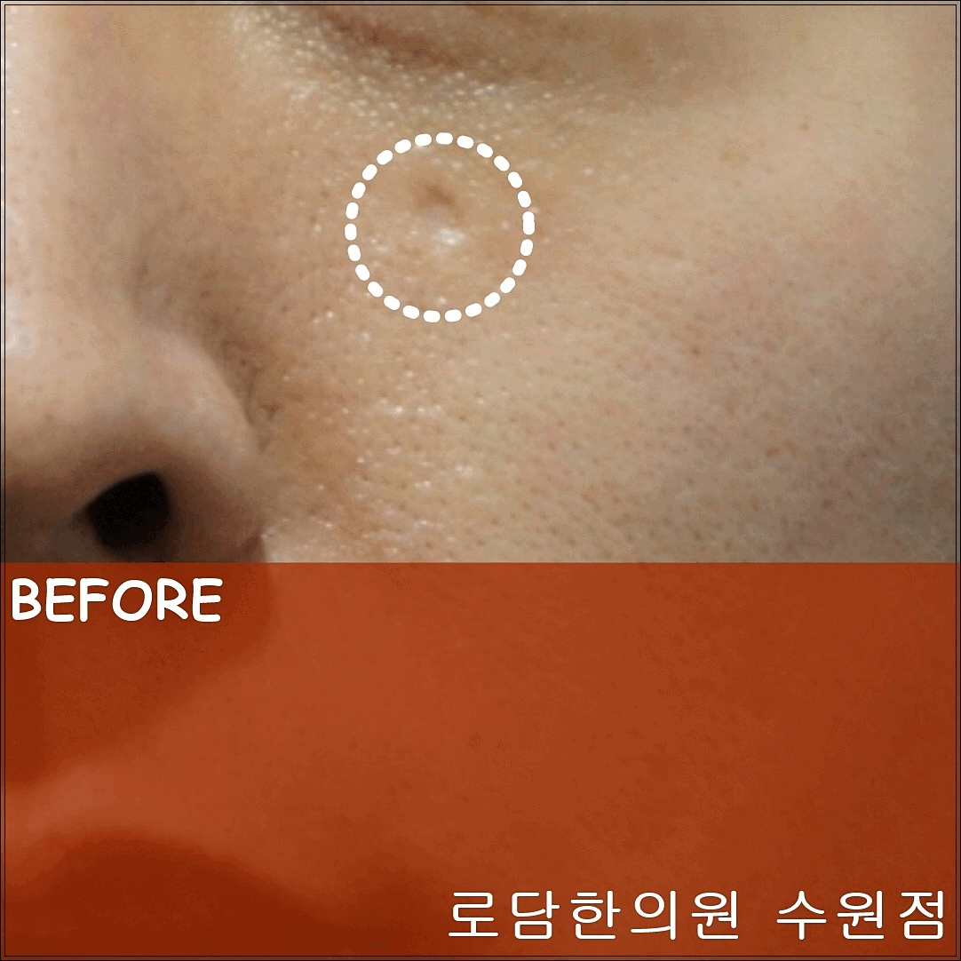  새살침 볼 수두 자국 흉터 치료 과정
