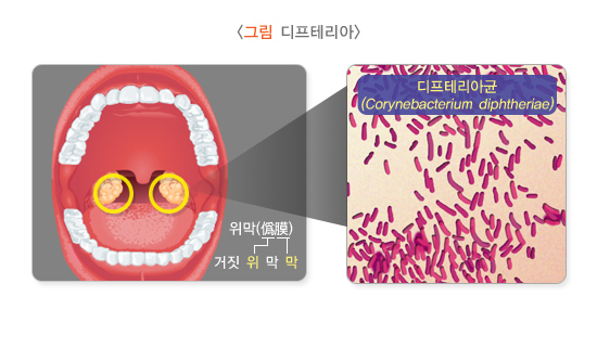  디프테리아