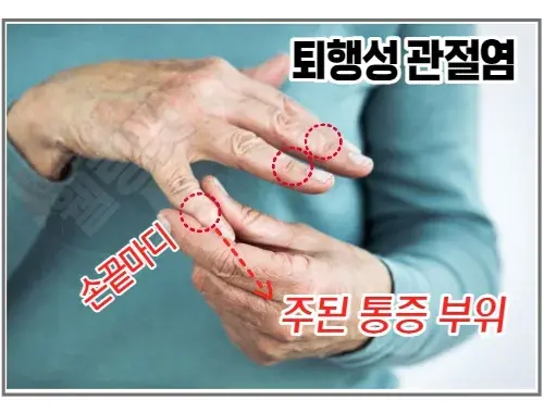 손가락-퇴행성-관절염-증상