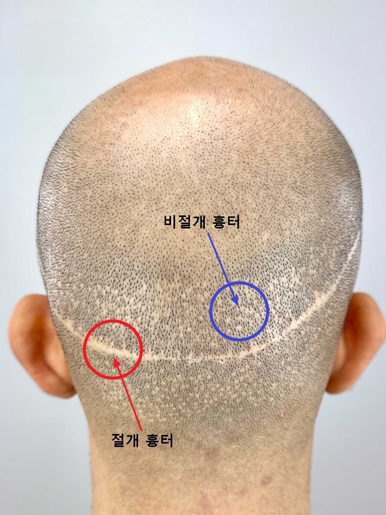 모발이식 절개 및 비절개 흉터