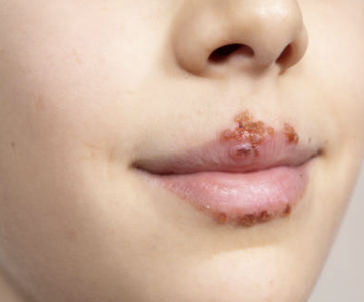 남성의 헤르페스 2형