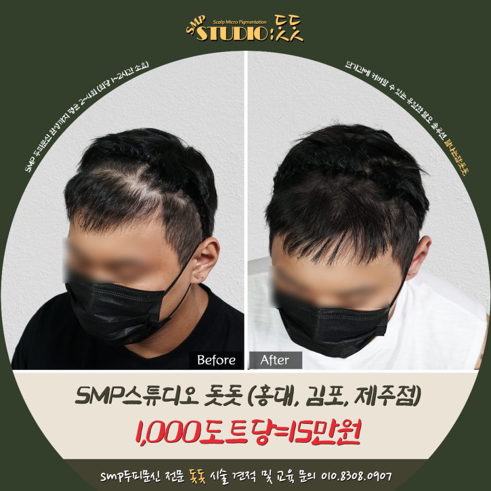  smp 두피문신 가격 그리고 커버 효과?