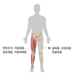  육종암 증상 및 원인 (골육종, 연부조직육종 치료)