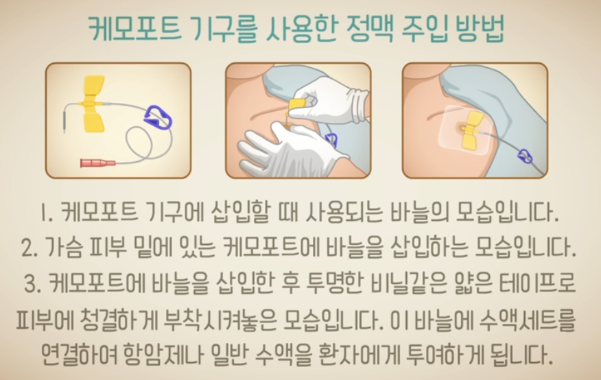 출처; 국립암센터 케모포트 기구를 통한 정맥 주입방법