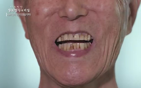 [792회] 생로병사의 비밀 - KBS[세균의 습격, 당신의 잇몸을 지켜라!] 감기보다 병원을 더 자주 찾게 만드는 질병이 있다. 바로 치주질환이다. 2020년 외래 다빈도 질병 1위를 차지한 치은염 및 치주질환 환자는 1,637_20220505_141551.466.jpg