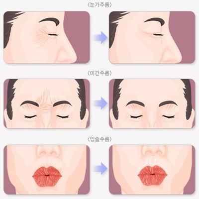 눈-코-입-주변-얼굴주름