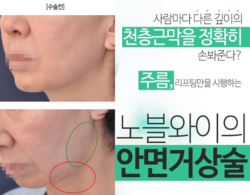  안면거상리프팅 나이를거꾸로