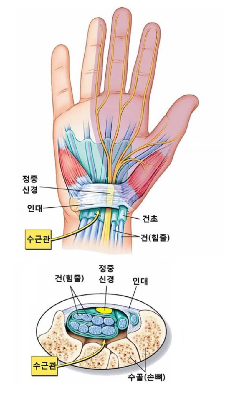 손목-터널-증후군