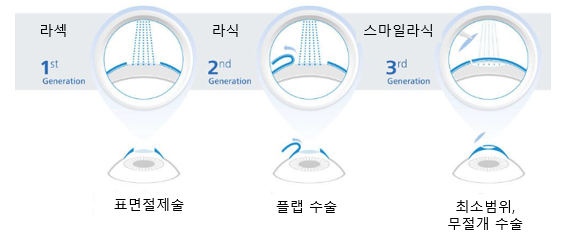 라섹&#44;라식&#44;스마일라식&#44;렌즈삽입술 수술방법